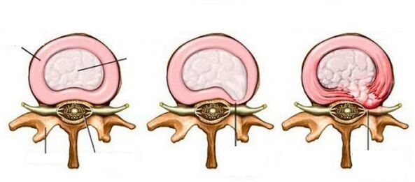 Hernie vertebrală intermediară cu osteocondroză cervicală