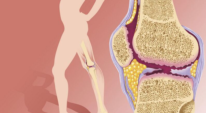 Excesul de greutate duce la osteoartrita