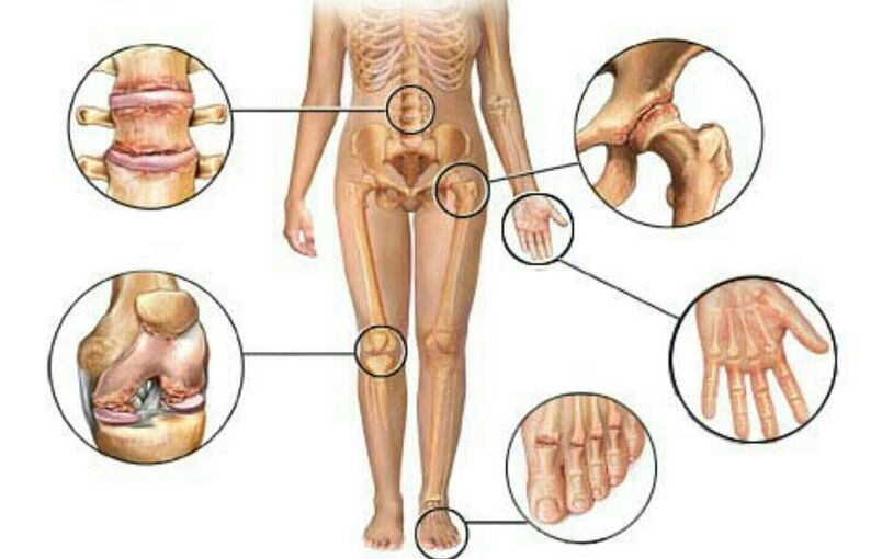 Tipuri și grade de osteoartrită
